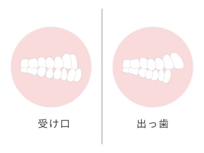 受け口や出っ歯のお子様