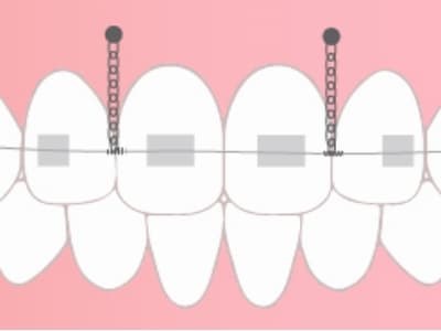 ガミースマイルにお悩みの方へ