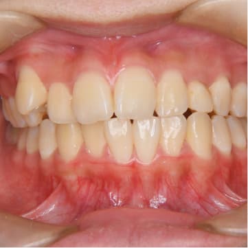 先天性欠損歯（歯がない）