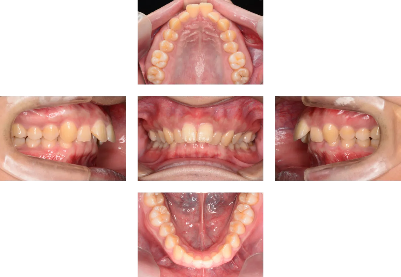 過蓋咬合（ディープバイト）の治療例 | 福岡・天神のしもだ矯正