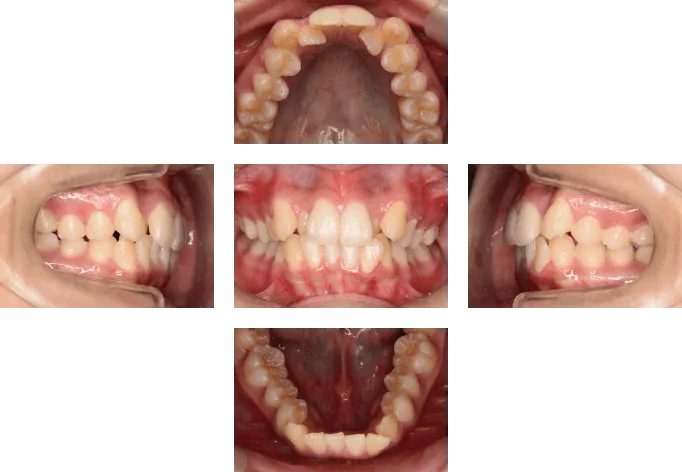 交叉咬合（クロスバイト）の治療例 | 福岡・天神のしもだ矯正歯科