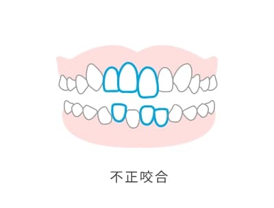 不正咬合