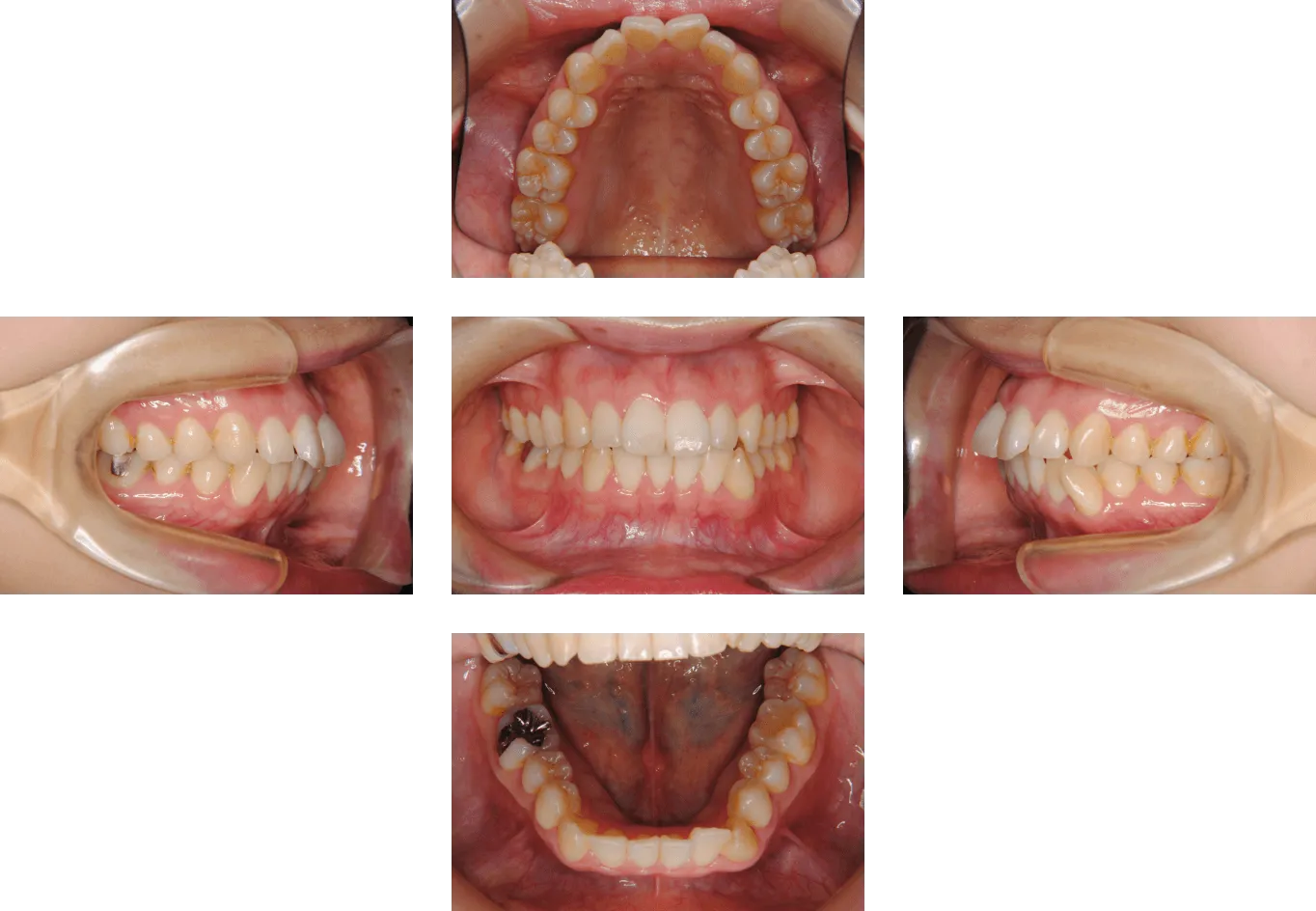 マウスピース型矯正装置（インビザライン）｜福岡天神しもだ矯正歯科