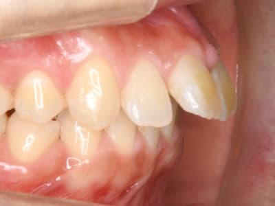 骨格性の出っ歯